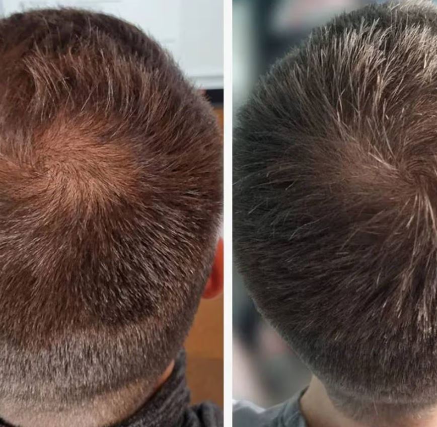 قرص کاهش ریزش مو پریورین بهتره یا نورکرین؟ بررسی تفاوت ها و شباهت ها 5 قرص کاهش ریزش مو پریورین بهتره یا نورکرین؟ بررسی تفاوت ها و شباهت ها